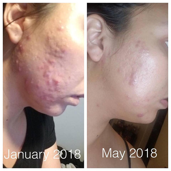 Organisk Acne Fighter Serum – Naturlig Behandling mod Akne & Ar