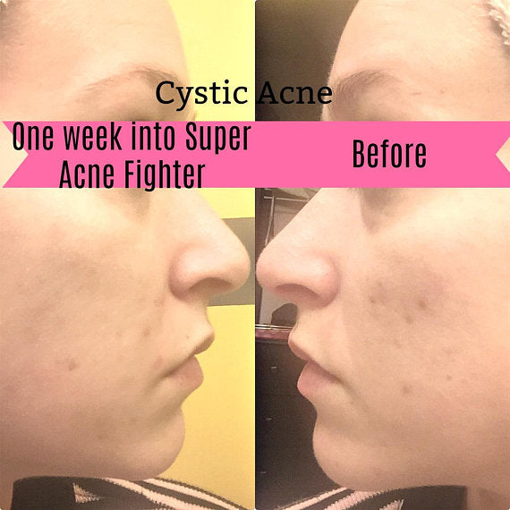Organisk Acne Fighter Serum – Naturlig Behandling mod Akne & Ar